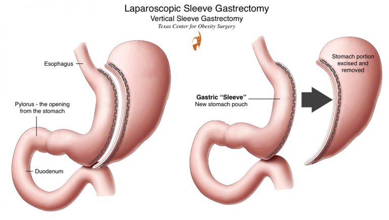 Sleeve Gastrectomy Weightloss surgery 768x435
