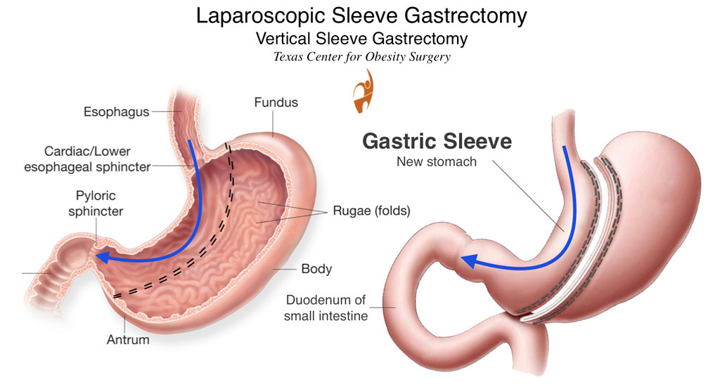 Sleeve gastrectomy Drs Cribbins and Hamn 2