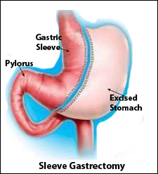 gastrectomy2