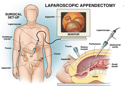 appendicitis surgery 28 appendectomy 29 500x500